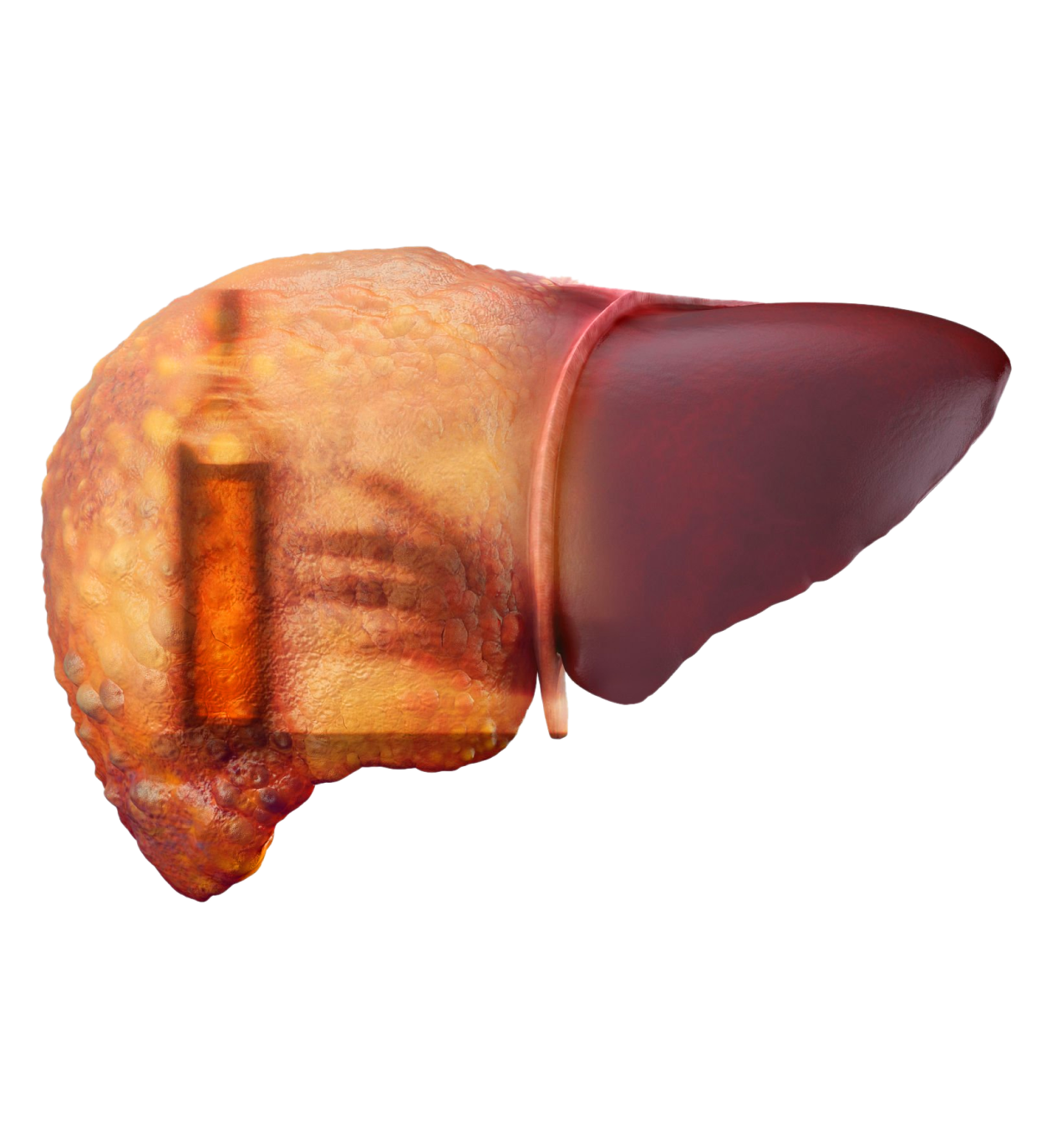 Alcoholic Hepatitis Treatment Overview