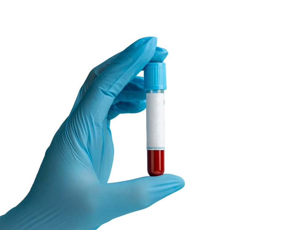 Diagnosis of Alcoholic Hepatitis