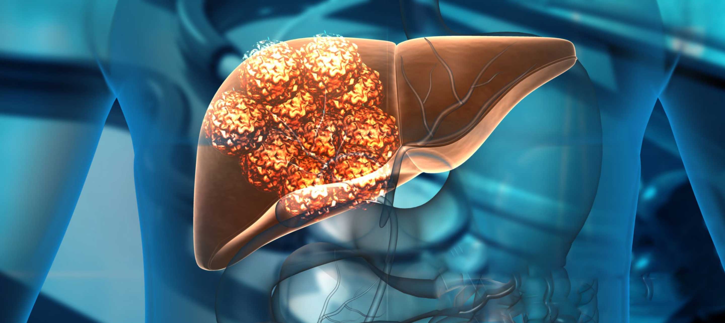 Chronic Hepatitis Treatment & Cost in Lucknow, India