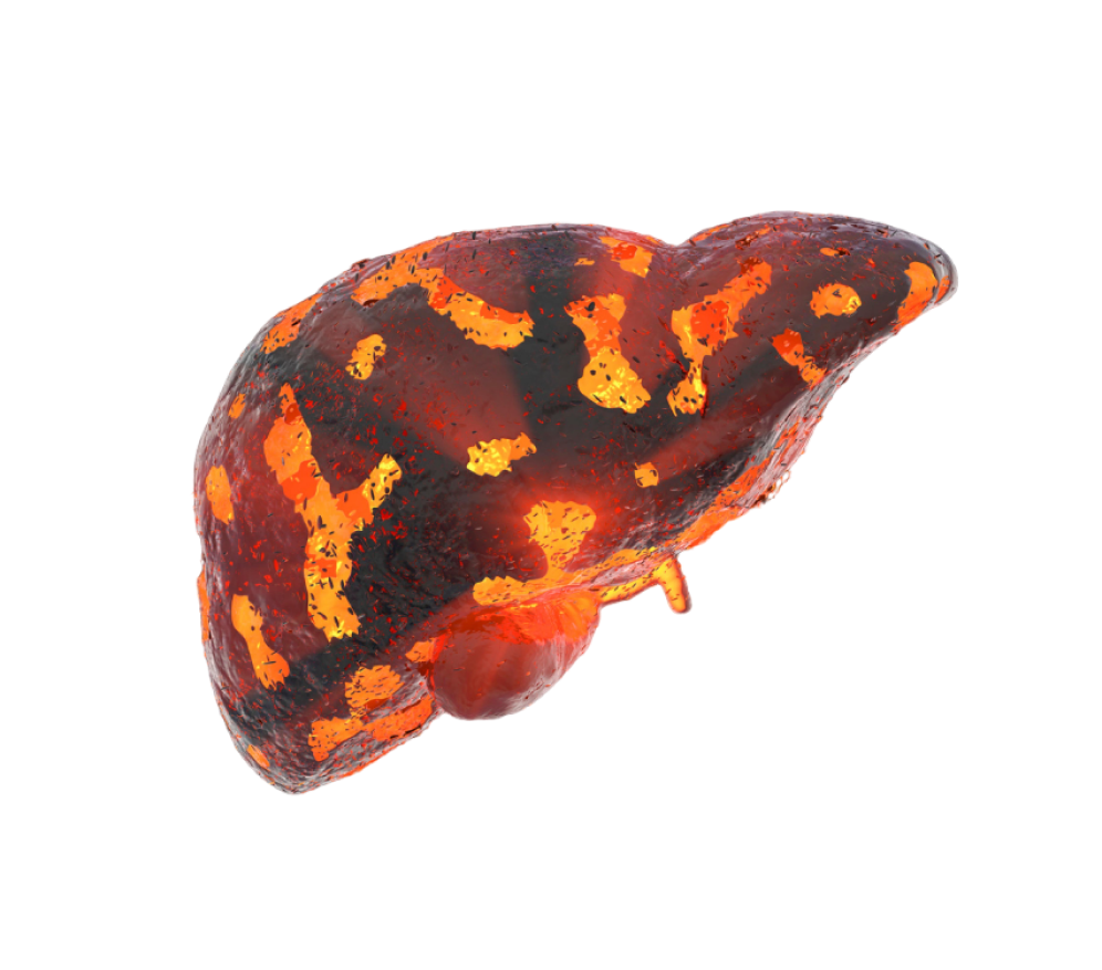 Symptoms of Liver Cirrhosis