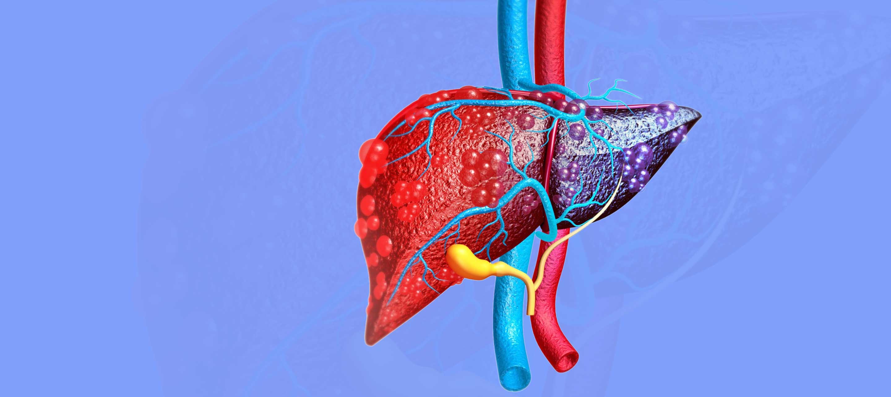 Liver Cirrhosis Treatment Cost in Lucknow, India