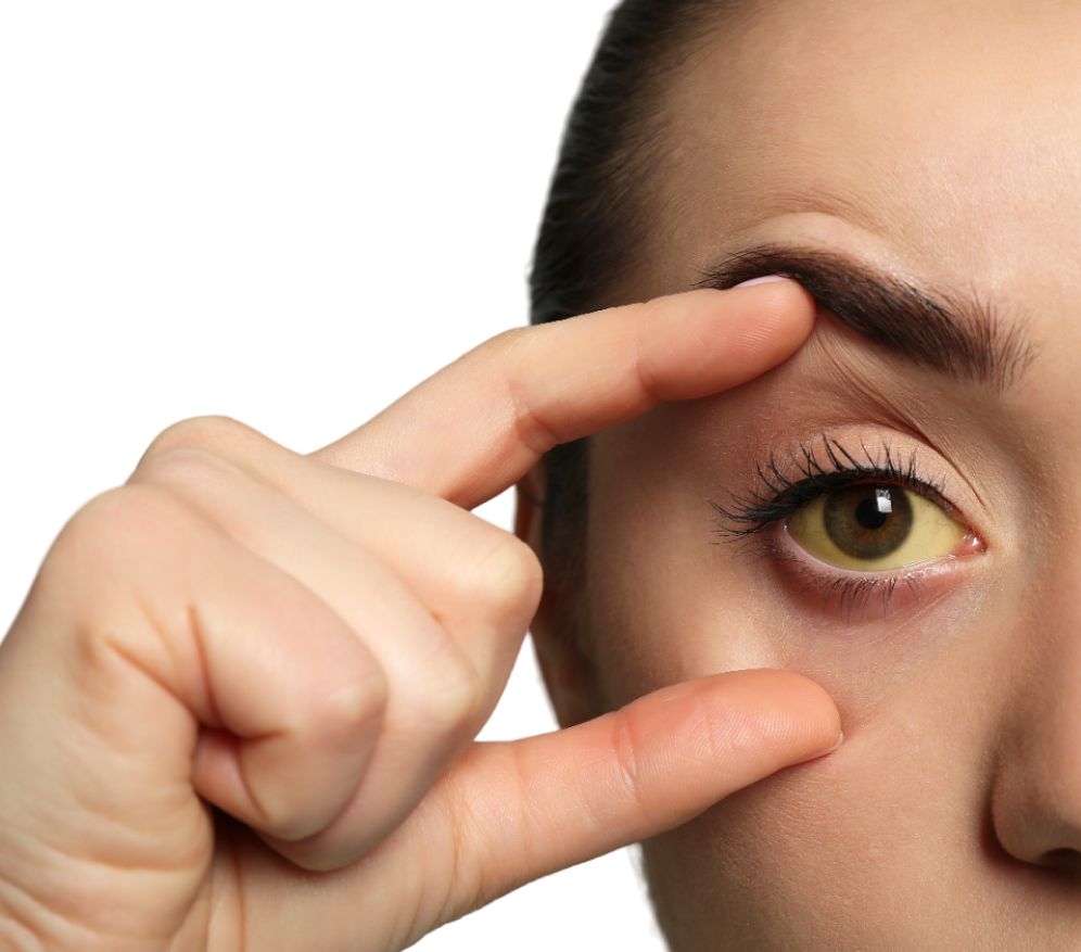 Jaundice Treatment Overview