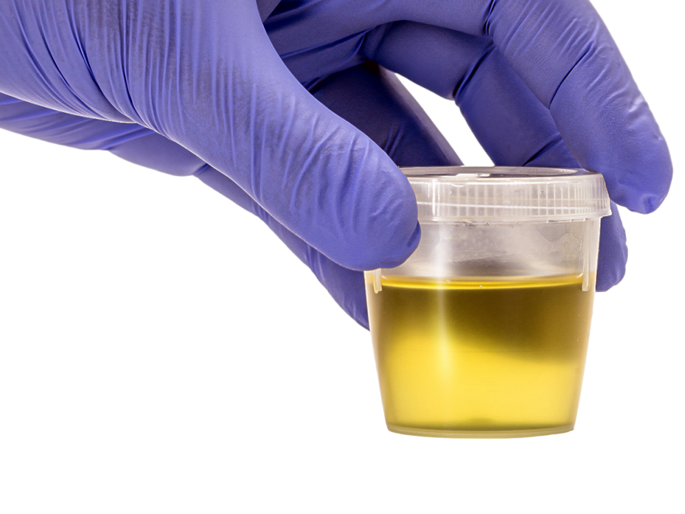 Diagnosis and tests of Jaundice