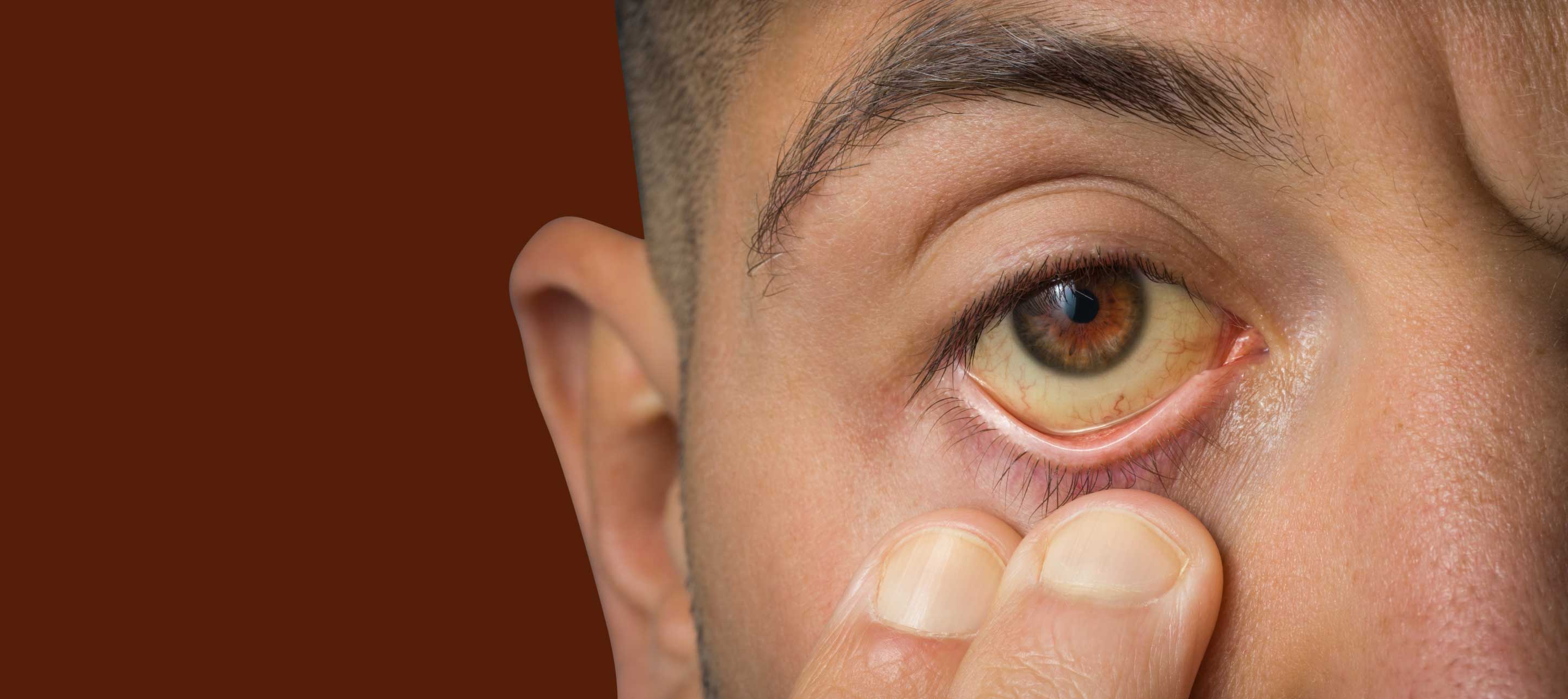 Jaundice Treatment Cost in Lucknow, India